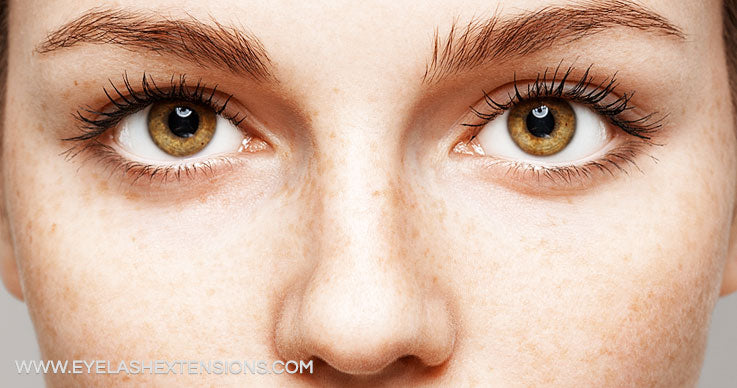 Facing up to freckles